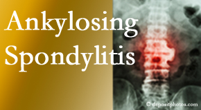 Ankylosing spondylitis is gently cared for by your St Peters chiropractor.