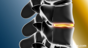 St Peters degenerative spinal changes 