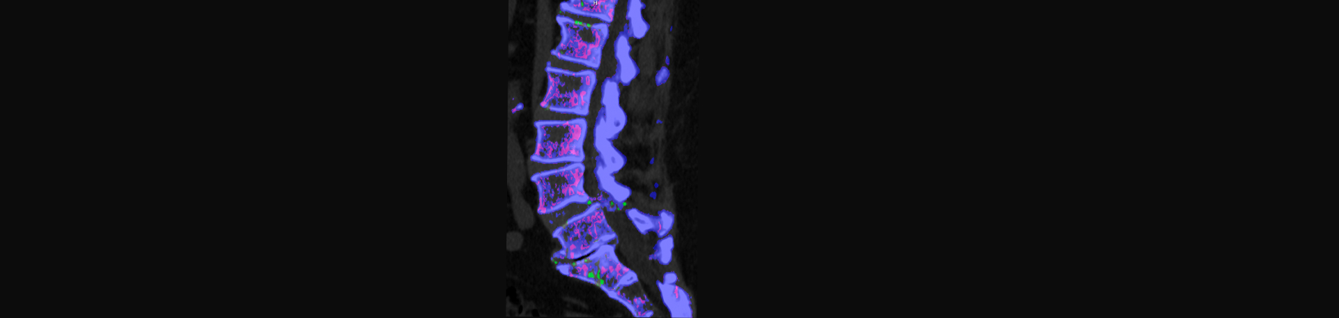 Old Mill Chiropractic is aware that inflammatory spinal gout is a differential diagnosis to consider for patients who present with back pain and other spine related symptoms.