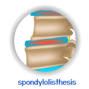 picture of St Peters chiropractic spondylolisthesis